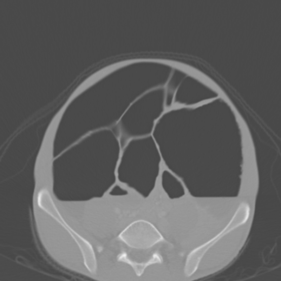 File:Chronic large bowel pseudo-obstruction (Radiopaedia 43181-46492 Axial bone window 123).jpg