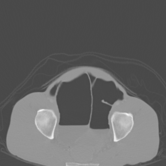 File:Chronic large bowel pseudo-obstruction (Radiopaedia 43181-46492 Axial bone window 148).jpg