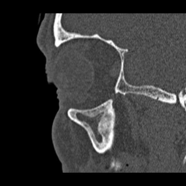 Chronic maxillary sinusitis (Radiopaedia 27879-28116 Sagittal bone window 49).jpg