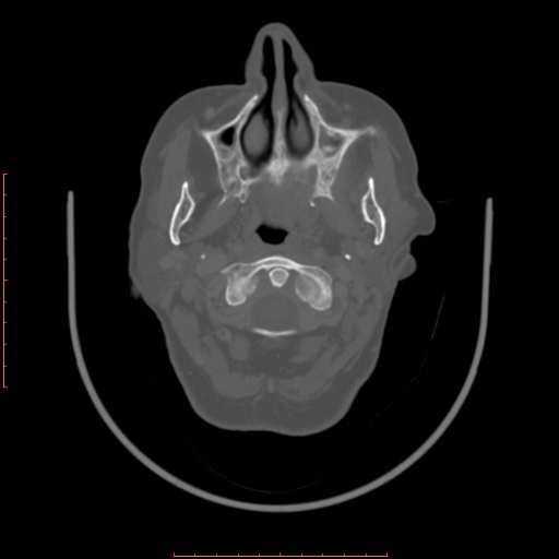Chronic osteomyelitis - maxilla (Radiopaedia 23783-23927 Axial bone window 91).jpg