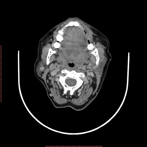 File:Chronic osteomyelitis - maxilla (Radiopaedia 23783-23927 B 43).jpg