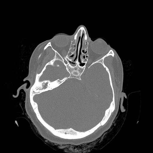Chronic sinusitis with intra-sinus calcification (Radiopaedia 63919-72668 Axial bone window 21).jpg