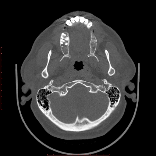 File:Chronic submandibular sialolithiasis (Radiopaedia 69817-79814 Axial bone window 3).jpg