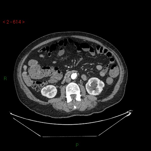 File:Circumaortic left renal vein and doubled left renal arteries (Radiopaedia 52268-58158 A 150).jpg