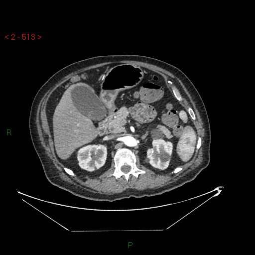 File:Circumaortic left renal vein and doubled left renal arteries (Radiopaedia 52268-58158 A 49).jpg