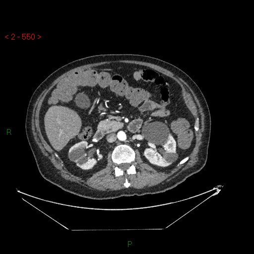File:Circumaortic left renal vein and doubled left renal arteries (Radiopaedia 52268-58158 A 86).jpg