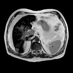 File:Cirrhosis and hepatocellular carcinoma in the setting of hemochromatosis (Radiopaedia 75394-86594 Axial T2 17).jpg