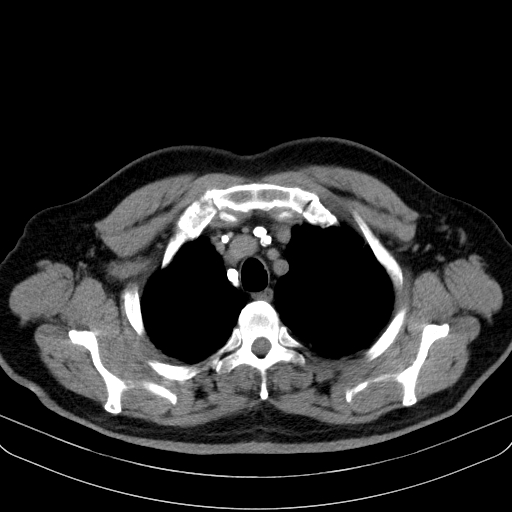 File:Classic complicated silicosis (Radiopaedia 49720-54961 Axial liver window 9).jpg