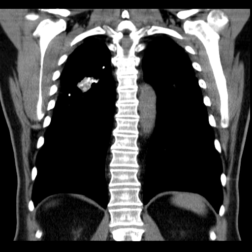 File:Classic complicated silicosis (Radiopaedia 49720-54961 Coronal liver window 46).jpg