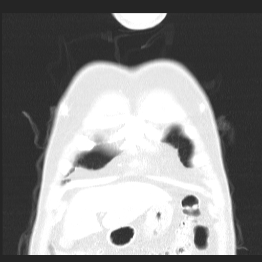 File:Classic complicated silicosis (Radiopaedia 49720-54961 Coronal lung window 1).jpg