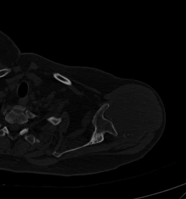 Clear cell chondrosarcoma - humerus (Radiopaedia 63104-71612 Axial bone window 27).jpg