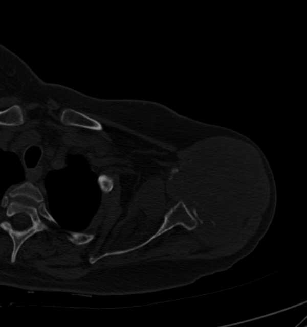 Clear cell chondrosarcoma - humerus (Radiopaedia 63104-71612 Axial bone window 33).jpg