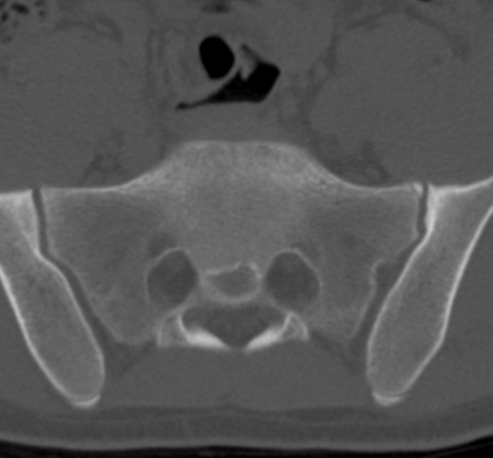 Clear cell meningoma - lumbar spine (Radiopaedia 60116-67691 Axial bone window 72).png