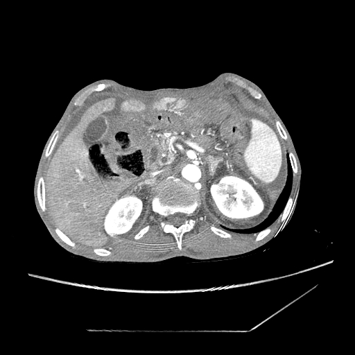 Closed-loop obstruction due to peritoneal seeding mimicking internal hernia after total gastrectomy (Radiopaedia 81897-95864 A 32).jpg
