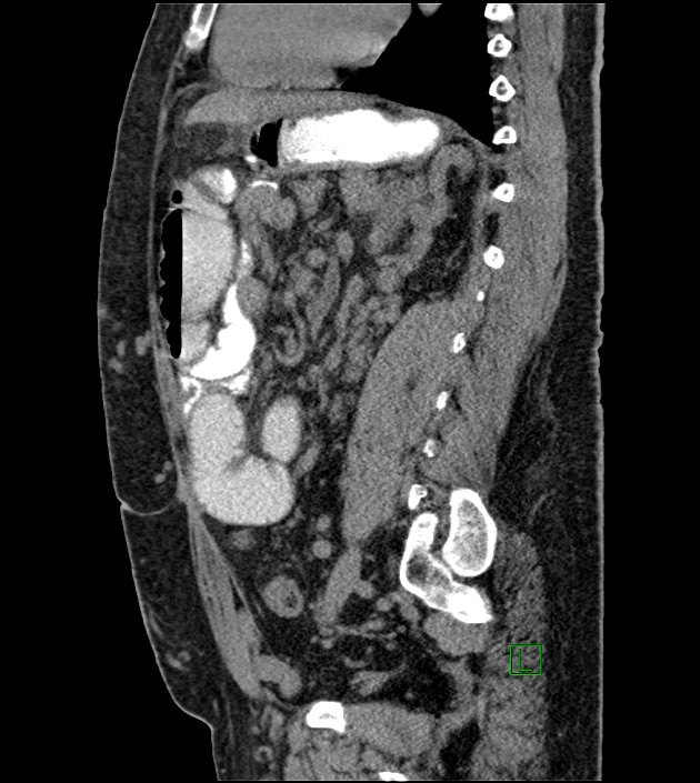 Closed-loop small bowel obstruction-internal hernia (Radiopaedia 78439-91096 C 64).jpg