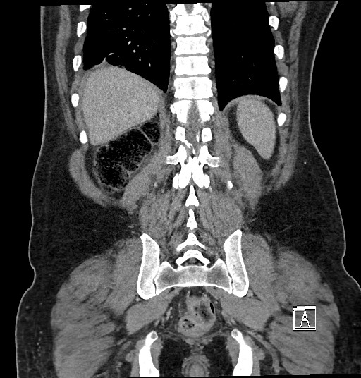 Closed loop obstruction - internal hernia into nephrectomy bed (Radiopaedia 59867-67320 B 113).jpg