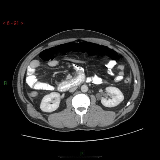 File:Closed loop obstruction and appendicular stump mucocele (Radiopaedia 54014-60163 A 49).jpg