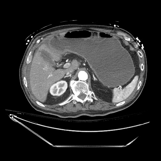 Closed loop obstruction due to adhesive band, resulting in small bowel ischemia and resection (Radiopaedia 83835-99023 B 42).jpg