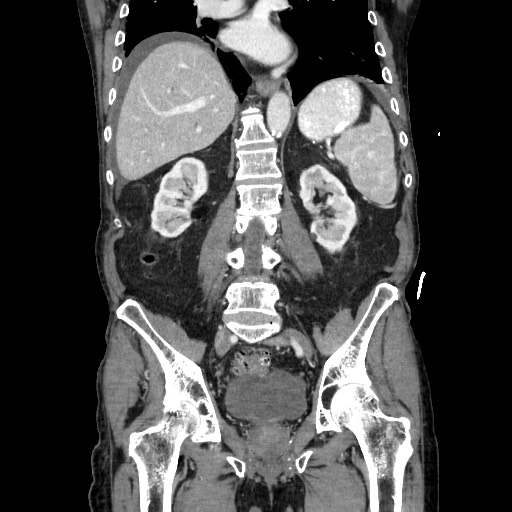 Closed loop small bowel obstruction - adhesive disease and hemorrhagic ischemia (Radiopaedia 86831-102990 B 83).jpg