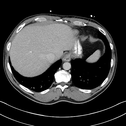 File:Closed loop small bowel obstruction - internal hernia (Radiopaedia 57806-64778 B 18).jpg