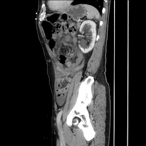 Closed loop small bowel obstruction - omental adhesion causing "internal hernia" (Radiopaedia 85129-100682 C 130).jpg