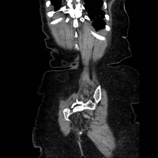 Closed loop small bowel obstruction due to adhesive band, with intramural hemorrhage and ischemia (Radiopaedia 83831-99017 C 110).jpg
