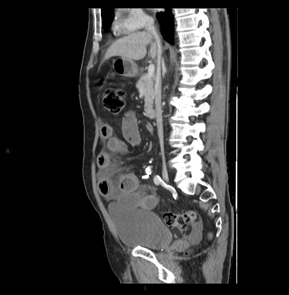 Closed loop small bowel obstruction with ischemia (Radiopaedia 84180-99456 C 42).jpg