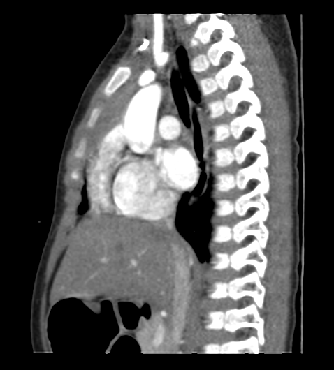 File:Coarctation of aorta (Radiopaedia 27427-27622 Sagittal C+ CTPA 54).png