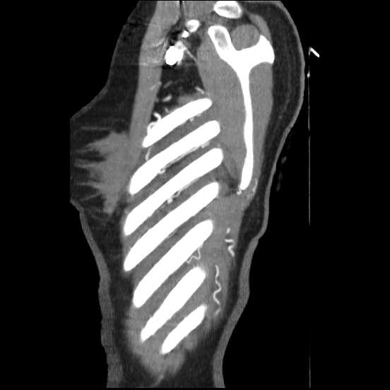 Coarctation of the aorta (Radiopaedia 67609-77010 C 5).jpg