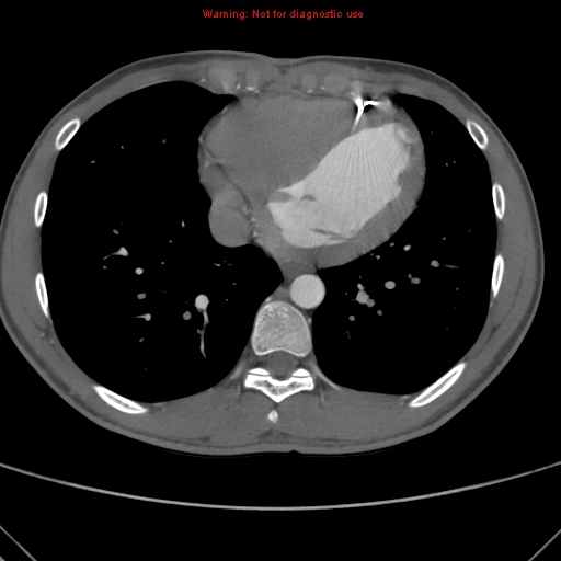 File:Coarctation of the aorta (Radiopaedia 9434-10118 A 138).jpg