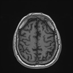 File:Cochlear incomplete partition type III associated with hypothalamic hamartoma (Radiopaedia 88756-105498 Axial T1 153).jpg