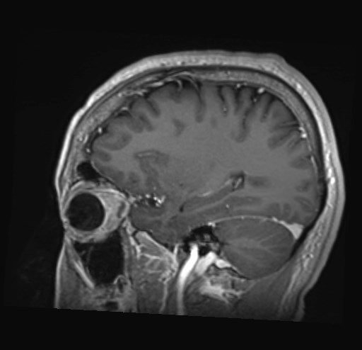 Cochlear incomplete partition type III associated with hypothalamic hamartoma (Radiopaedia 88756-105498 Sagittal T1 C+ 38).jpg