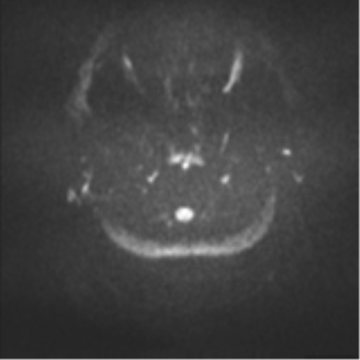 Colloid cyst (Radiopaedia 44510-48181 Axial DWI 28).png
