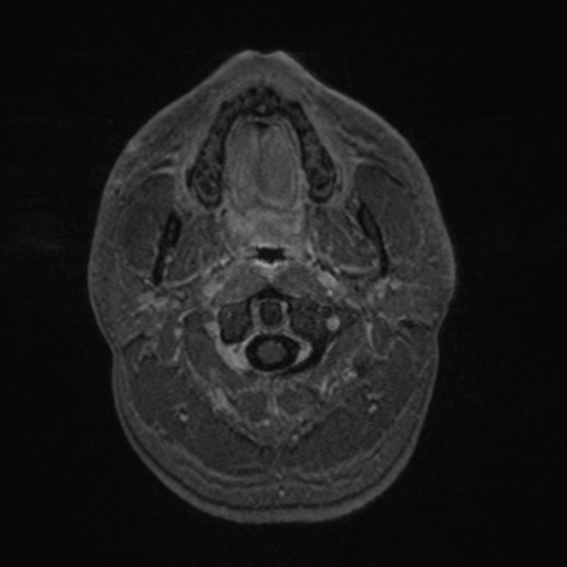 Colloid cyst (Radiopaedia 44510-48181 Axial T1 C+ 12).png