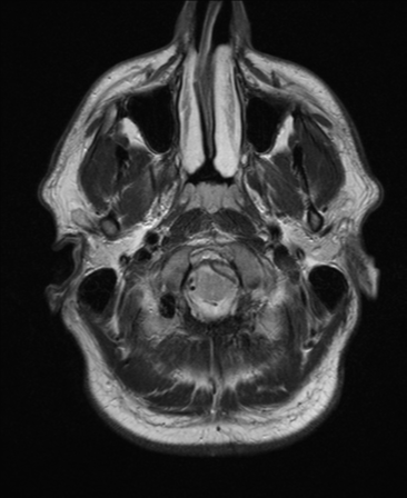 File:Colloid cyst (Radiopaedia 44510-48181 Axial T2 2).png