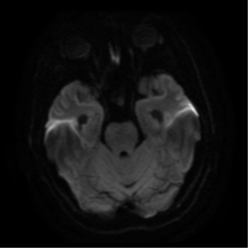 File:Colloid cyst (large) (Radiopaedia 34415-35729 Axial DWI 7).png