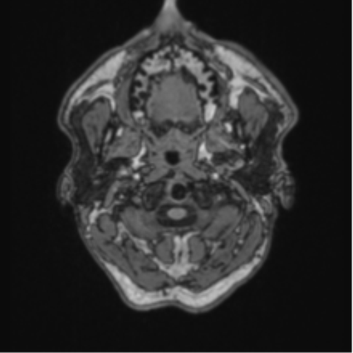 File:Colloid cyst of the third ventricle (Radiopaedia 86571-102662 Axial T1 1).png