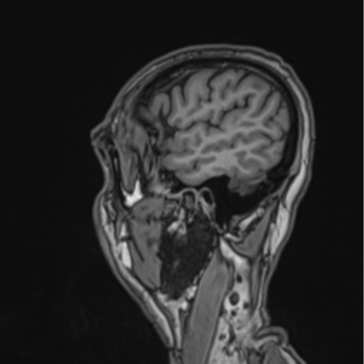 Colloid cyst of the third ventricle (Radiopaedia 86571-102662 Sagittal T1 13).png