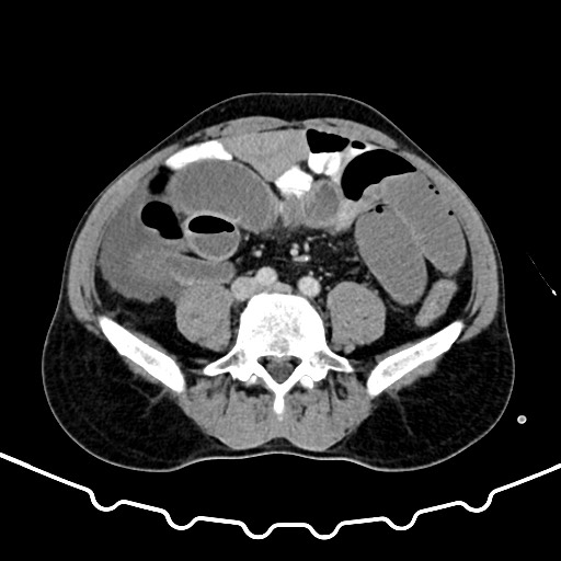 Colocolic intussusception due to large lipoma (Radiopaedia 68773-78482 A 123).jpg