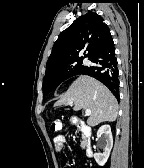 Colon adenocarcinoma (Radiopaedia 83266-97671 D 40).jpg