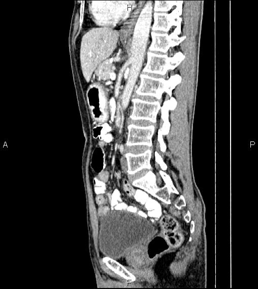 Colon adenocarcinoma - hepatic flexure (Radiopaedia 85635-101395 D 49).jpg