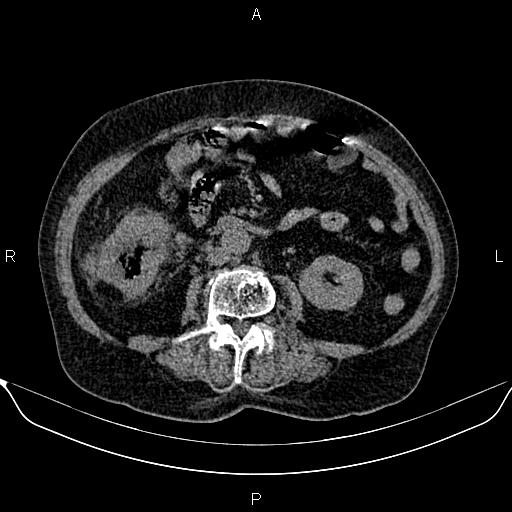 File:Colon cancer (Radiopaedia 90215-107432 Axial non-contrast 50).jpg