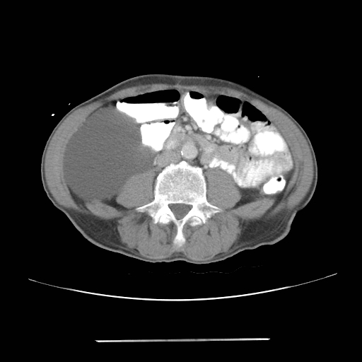File:Colon cancer with calcified liver metastasis (Radiopaedia 74423-85307 A 42).jpg