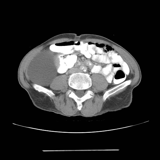 File:Colon cancer with calcified liver metastasis (Radiopaedia 74423-85307 A 45).jpg