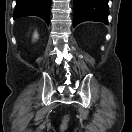 File:Colon cancer with duodenal invasion (Radiopaedia 16278-15958 B 48).jpg