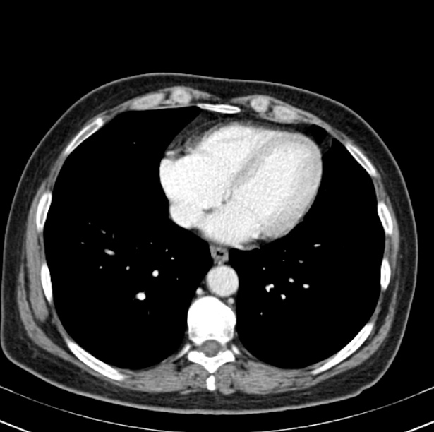 Colon carcinoma with hepatic metastases (Radiopaedia 29477-29961 A 2).jpg