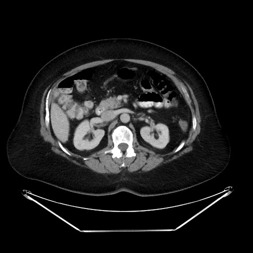 File:Colonic intussusception due to adenocarcinoma (Radiopaedia 86828-102987 Axial 57).jpg