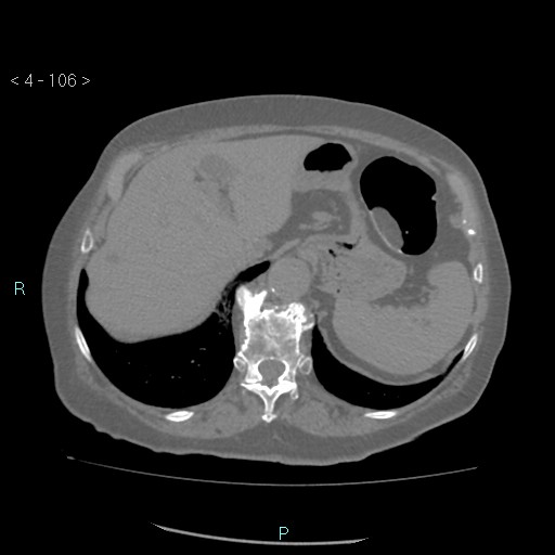 Colonic lipomas (Radiopaedia 49137-54244 Axial bone window 48).jpg