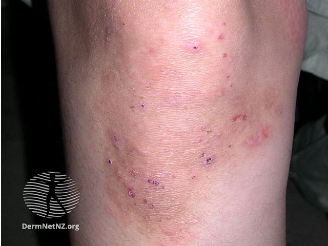 File:Dermatitis herpetiformis (DermNet NZ immune-dh3).jpg