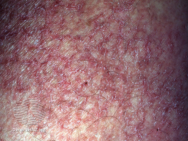 File:Eczema craquelé (DermNet NZ systemic-ecz-craq).jpg